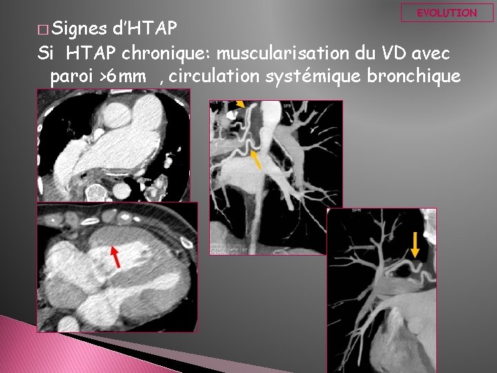 � Signes EVOLUTION d’HTAP Si HTAP chronique: muscularisation du VD avec paroi >6 mm