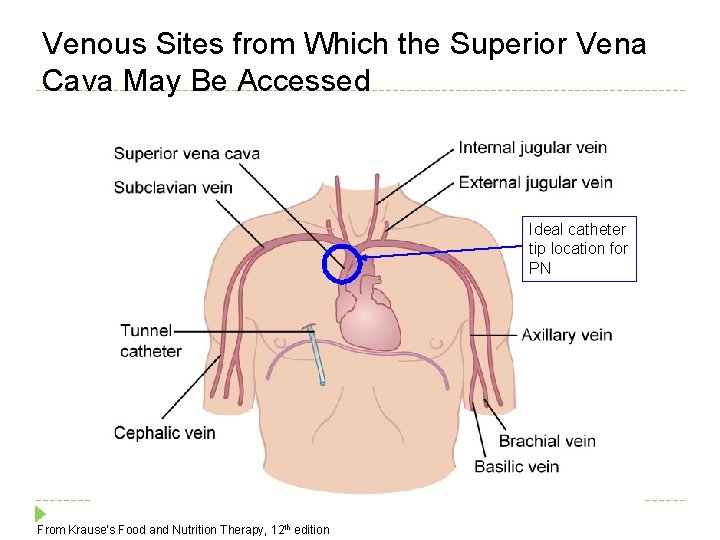 Venous Sites from Which the Superior Vena Cava May Be Accessed Ideal catheter tip