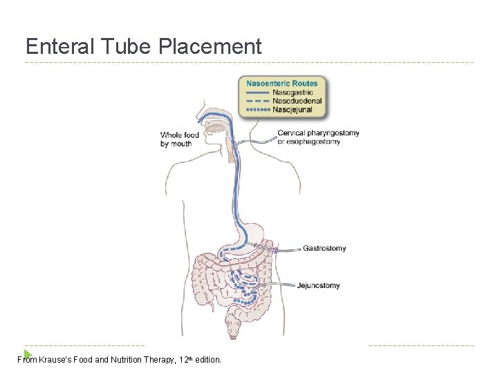 Enteral Tube Placement From Krause’s Food and Nutrition Therapy, 12 th edition. 