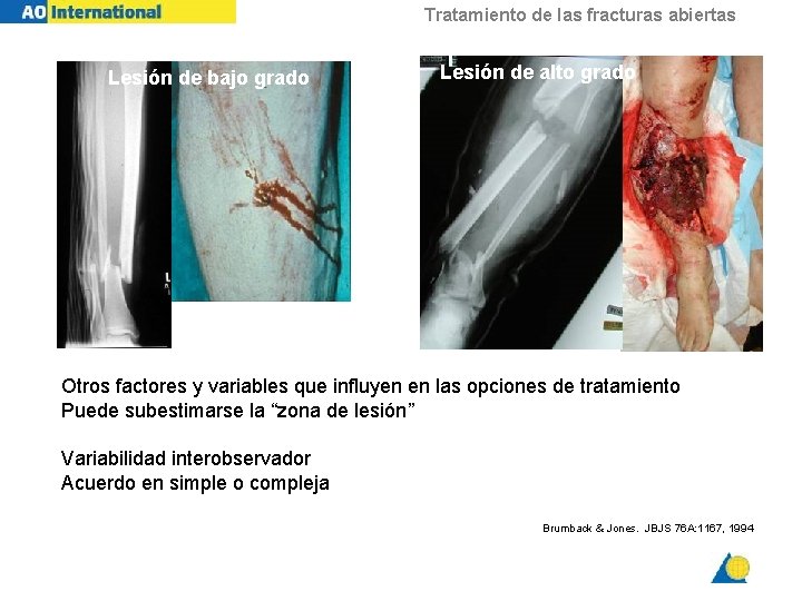 Tratamiento de las fracturas abiertas Lesión de bajo grado Lesión de alto grado Otros