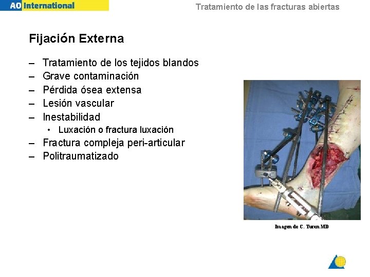 Tratamiento de las fracturas abiertas Fijación Externa – – – Tratamiento de los tejidos