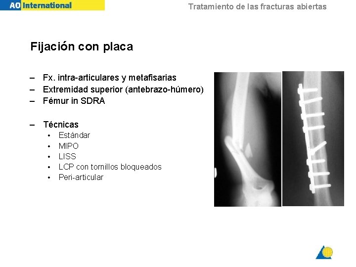 Tratamiento de las fracturas abiertas Fijación con placa – Fx. intra-articulares y metafisarias –