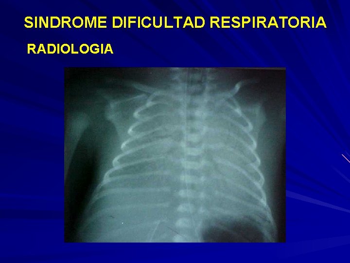 SINDROME DIFICULTAD RESPIRATORIA RADIOLOGIA 