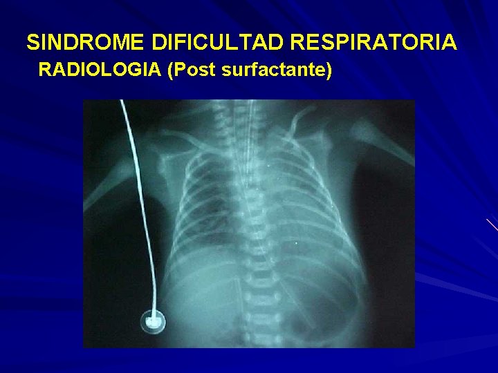 SINDROME DIFICULTAD RESPIRATORIA RADIOLOGIA (Post surfactante) 