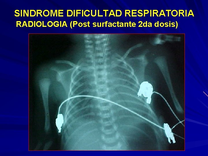 SINDROME DIFICULTAD RESPIRATORIA RADIOLOGIA (Post surfactante 2 da dosis) 