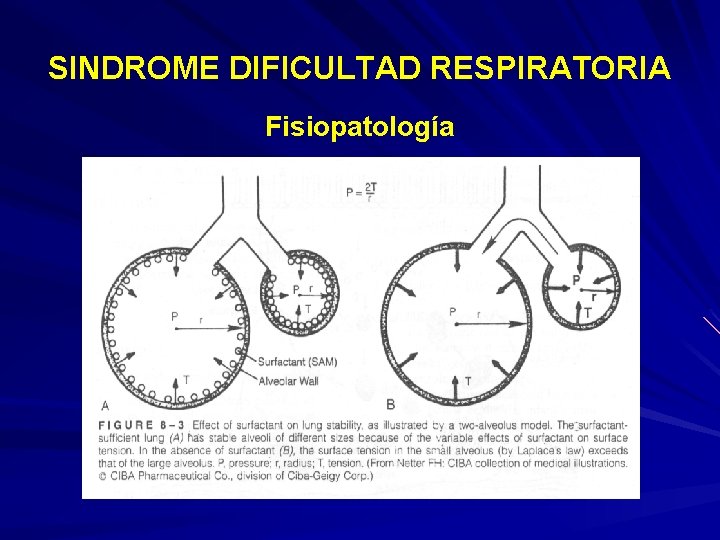 SINDROME DIFICULTAD RESPIRATORIA Fisiopatología 