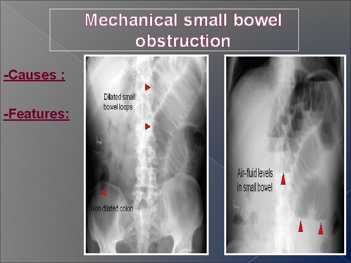 Mechanical small bowel obstruction -Causes : -Features: 