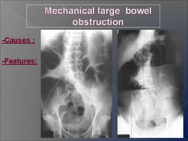 Mechanical large bowel obstruction -Causes : -Features: 