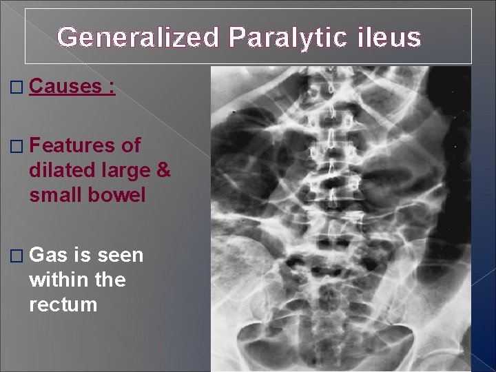 Generalized Paralytic ileus � Causes : � Features of dilated large & small bowel