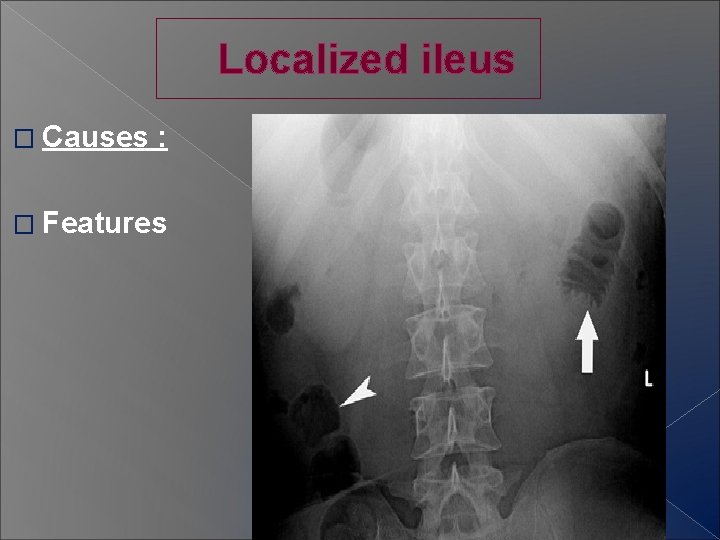 Localized ileus � Causes : � Features 