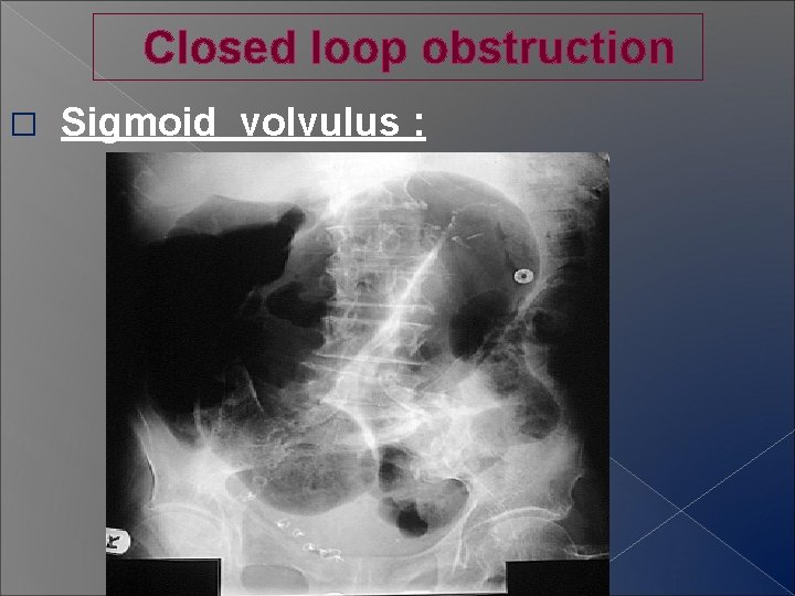 Closed loop obstruction � Sigmoid volvulus : 
