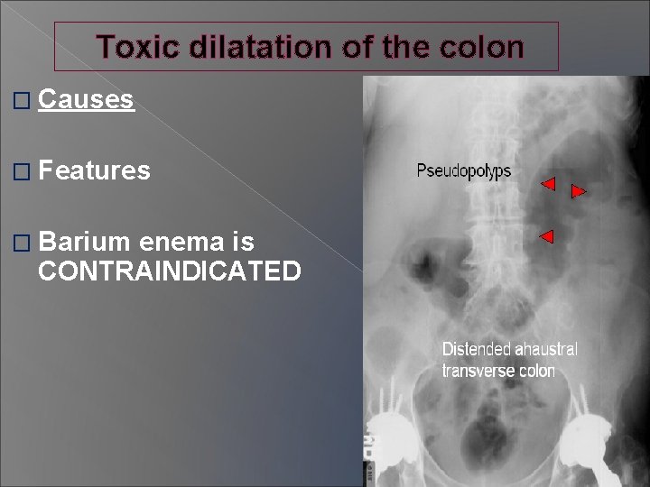 Toxic dilatation of the colon � Causes � Features � Barium enema is CONTRAINDICATED