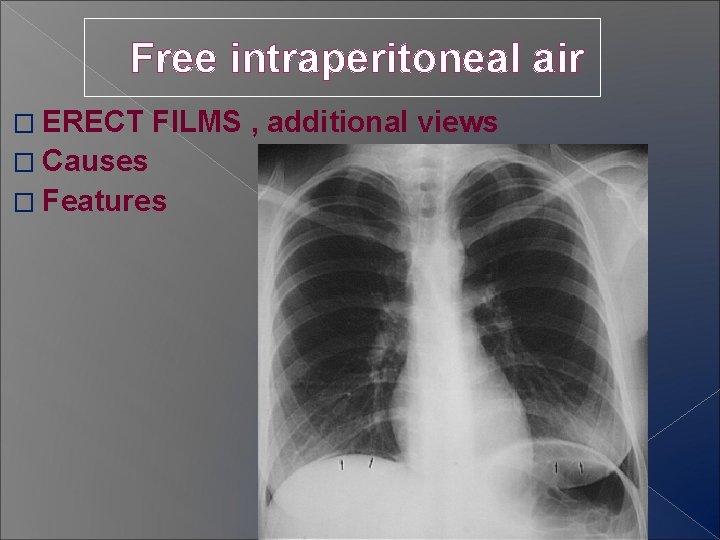 Free intraperitoneal air � ERECT FILMS , additional views � Causes � Features 