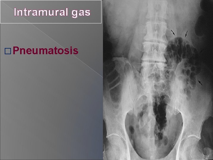 Intramural gas � Pneumatosis 