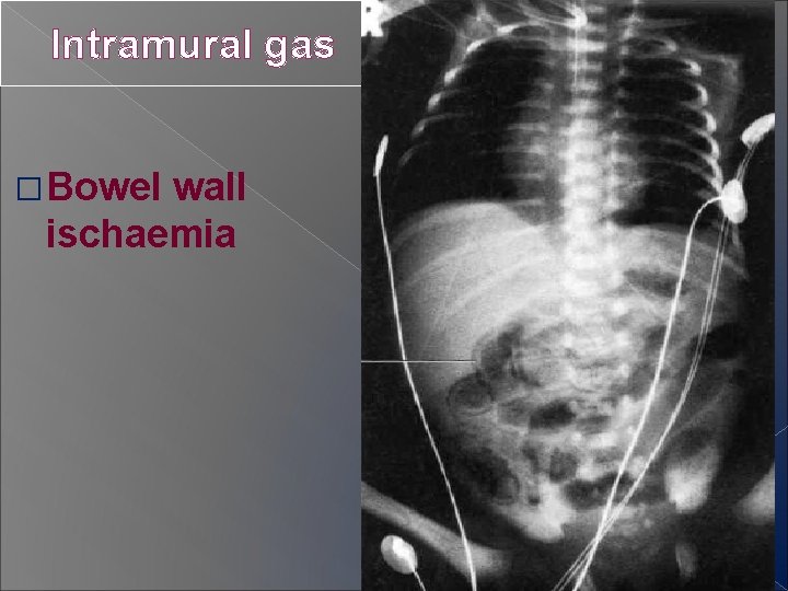 Intramural gas � Bowel wall ischaemia 