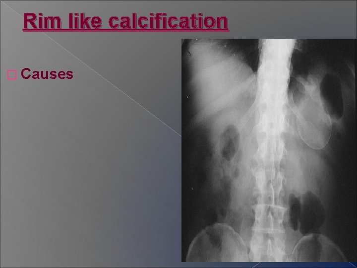 Rim like calcification � Causes 