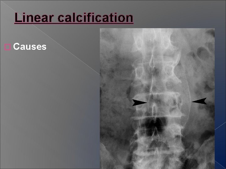 Linear calcification � Causes 