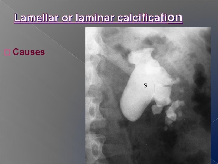 Lamellar or laminar calcification � Causes 