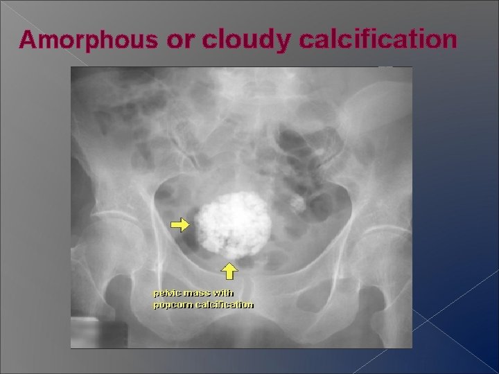 Amorphous or cloudy calcification 