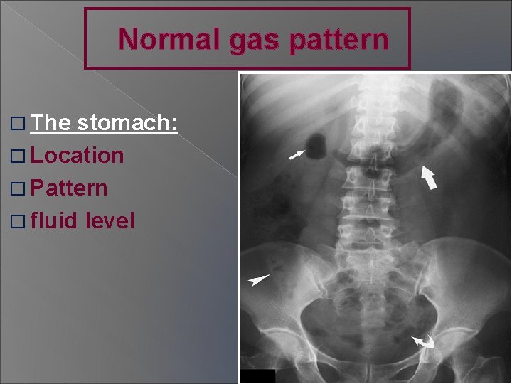 Normal gas pattern � The stomach: � Location � Pattern � fluid level 