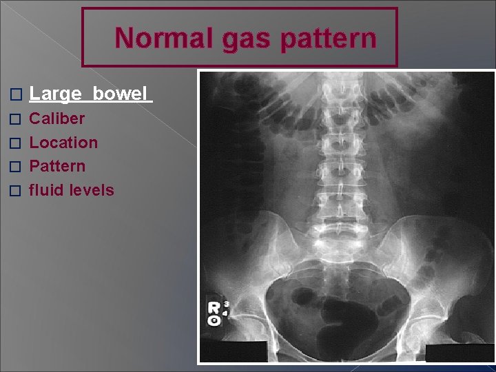 Normal gas pattern � Large bowel Caliber � Location � Pattern � fluid levels