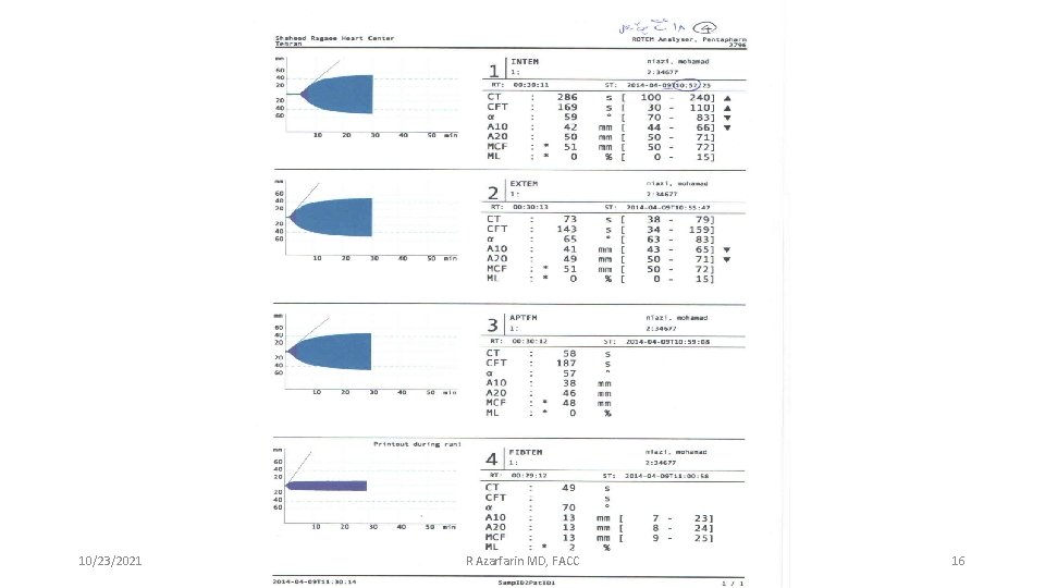 10/23/2021 R Azarfarin MD, FACC 16 