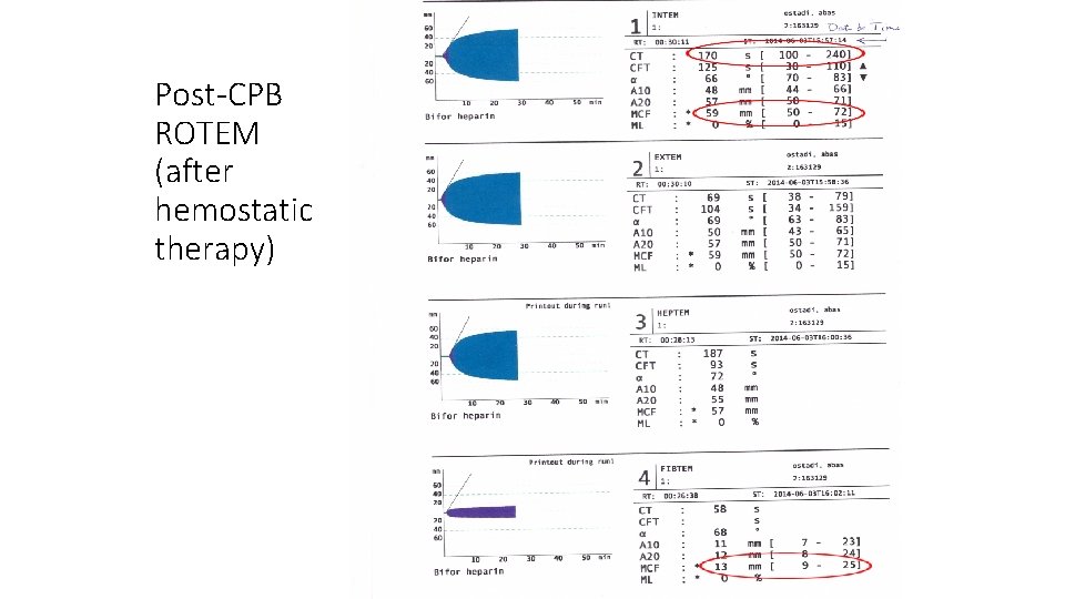 Post-CPB ROTEM (after hemostatic therapy) 