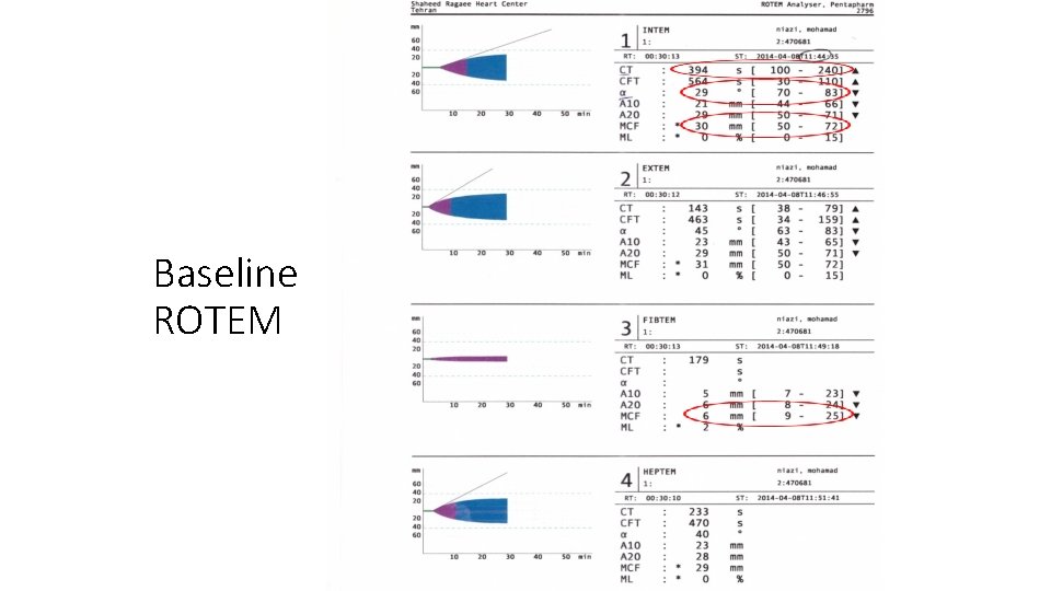 Baseline ROTEM 