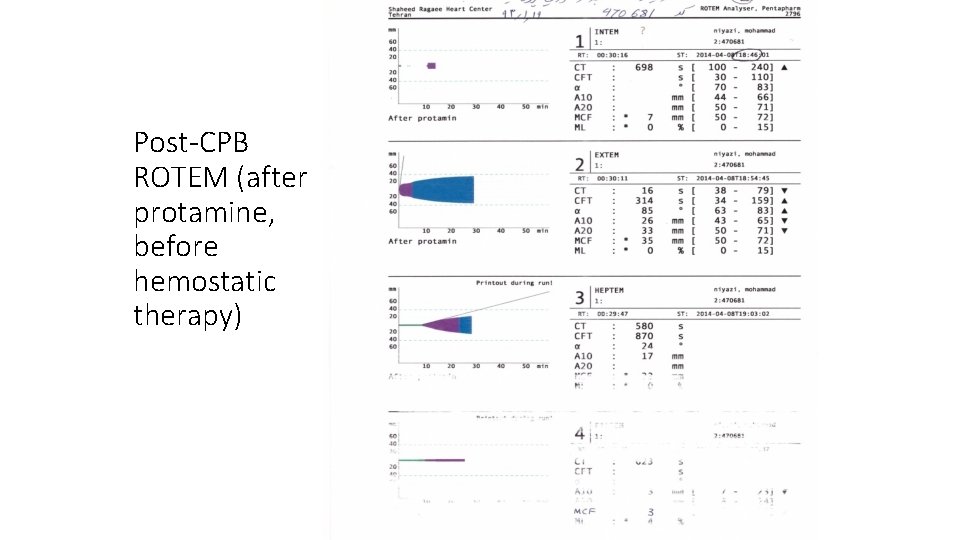 Post-CPB ROTEM (after protamine, before hemostatic therapy) 