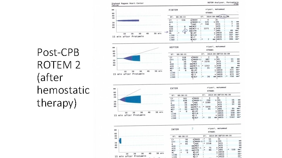 Post-CPB ROTEM 2 (after hemostatic therapy) 