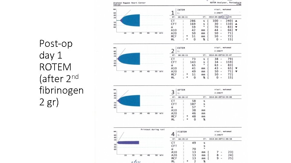 Post-op day 1 ROTEM (after 2 nd fibrinogen 2 gr) 