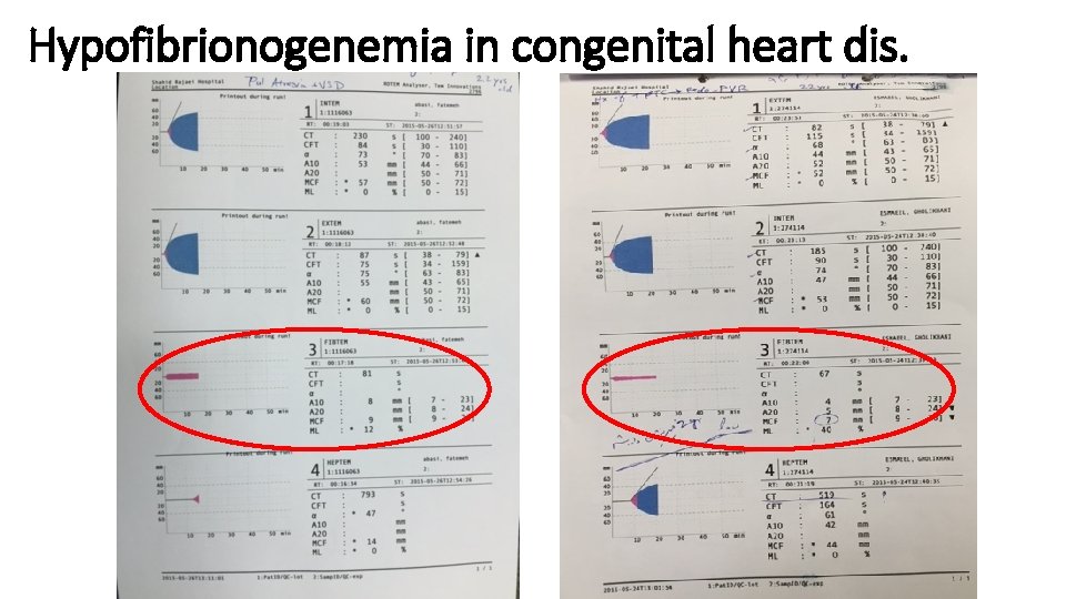 Hypofibrionogenemia in congenital heart dis. 