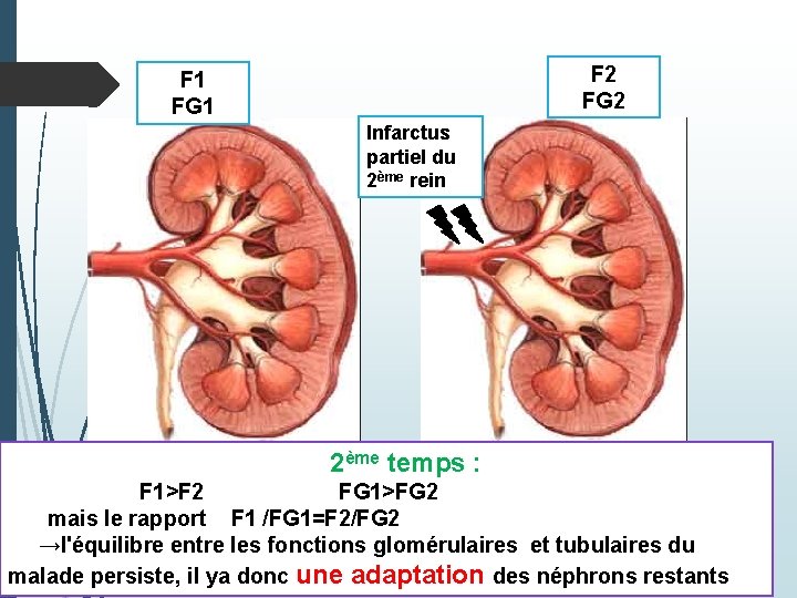 F 2 FG 2 F 1 FG 1 Infarctus partiel du 2ème rein 2ème