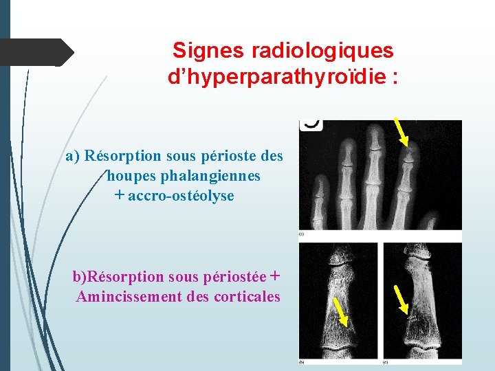 Signes radiologiques d’hyperparathyroïdie : a) Résorption sous périoste des houpes phalangiennes + accro-ostéolyse b)Résorption