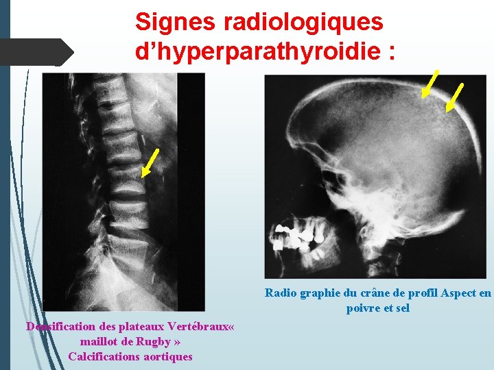 Signes radiologiques d’hyperparathyroidie : Radio graphie du crâne de profil Aspect en poivre et