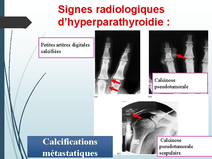 Signes radiologiques d’hyperparathyroidie : Petites artères digitales calcifiées Calcinose pseudotumorale Calcifications métastatiques Calcinose pseudotumorale