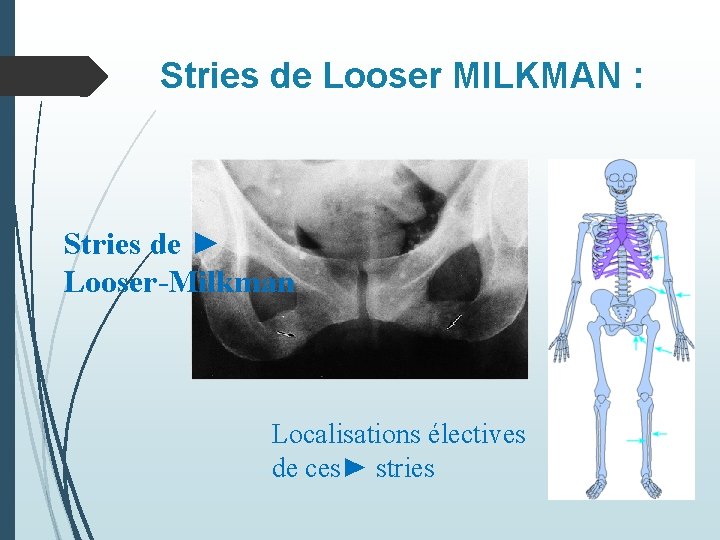 Stries de Looser MILKMAN : Stries de ► Looser-Milkman Localisations électives de ces► stries