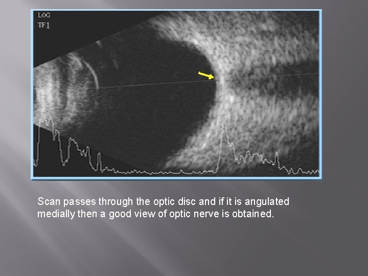 Scan passes through the optic disc and if it is angulated medially then a