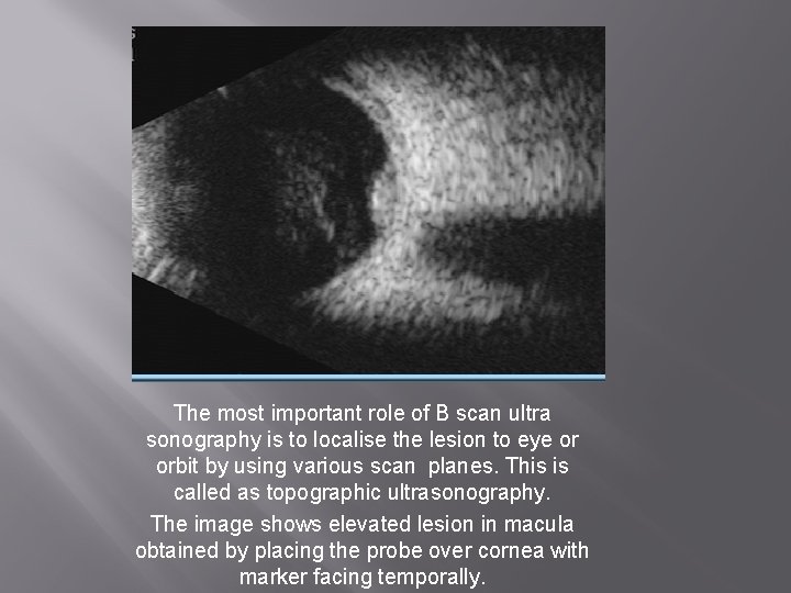 The most important role of B scan ultra sonography is to localise the lesion