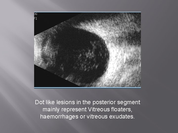 Dot like lesions in the posterior segment mainly represent Vitreous floaters, haemorrhages or vitreous