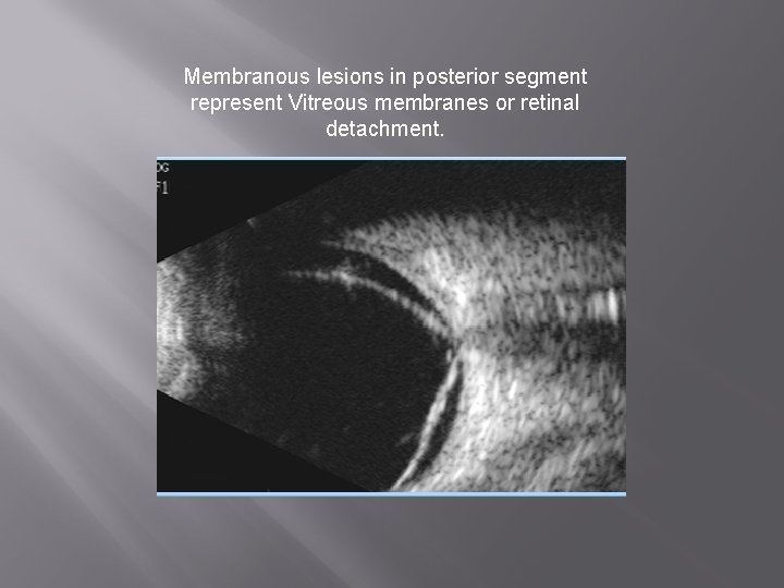Membranous lesions in posterior segment represent Vitreous membranes or retinal detachment. 