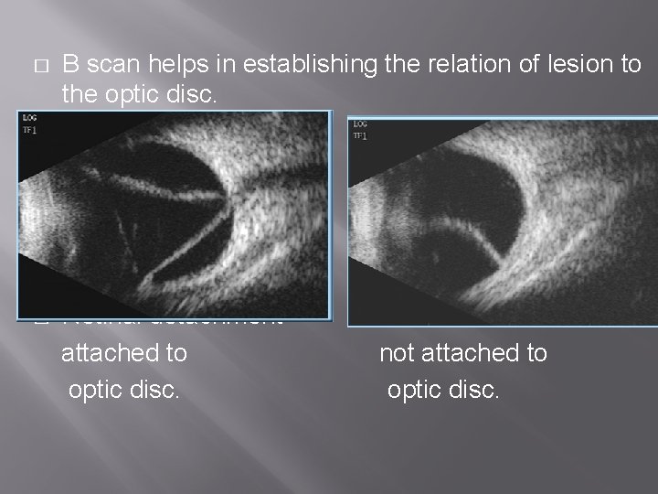 � B scan helps in establishing the relation of lesion to the optic disc.