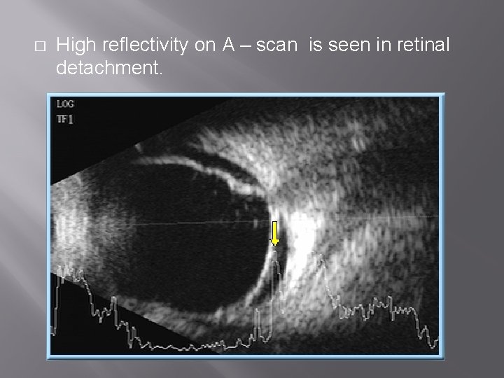 � High reflectivity on A – scan is seen in retinal detachment. 