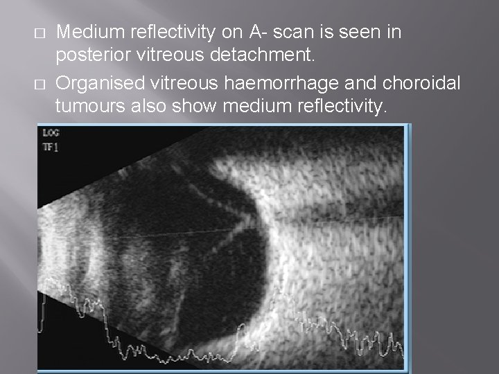 � � Medium reflectivity on A- scan is seen in posterior vitreous detachment. Organised