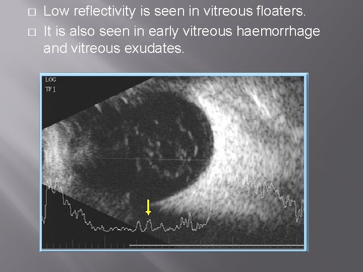 � � Low reflectivity is seen in vitreous floaters. It is also seen in