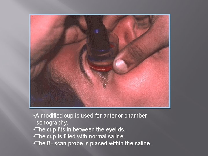  • A modified cup is used for anterior chamber sonography. • The cup