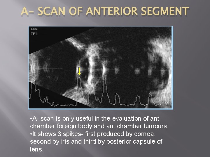 A- SCAN OF ANTERIOR SEGMENT • A- scan is only useful in the evaluation