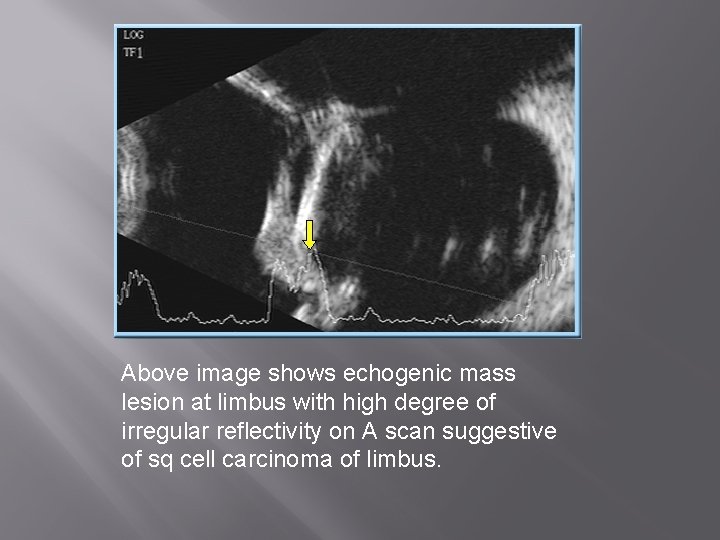 Above image shows echogenic mass lesion at limbus with high degree of irregular reflectivity