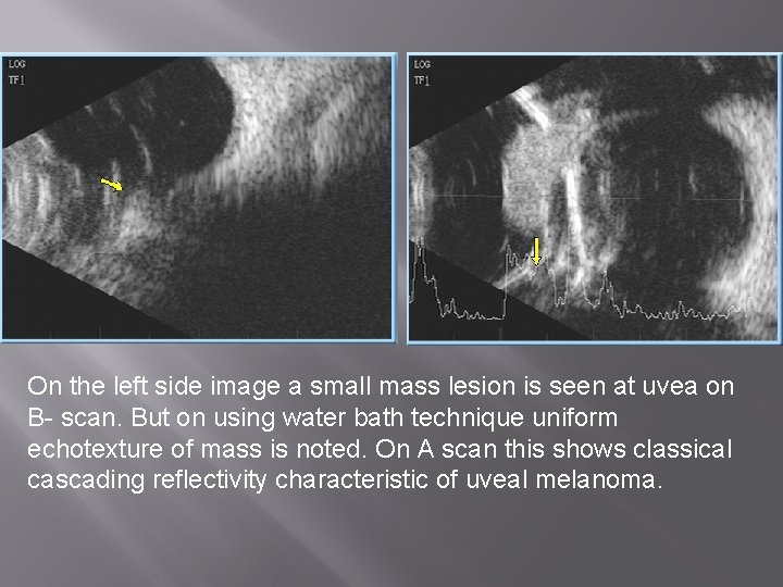 On the left side image a small mass lesion is seen at uvea on
