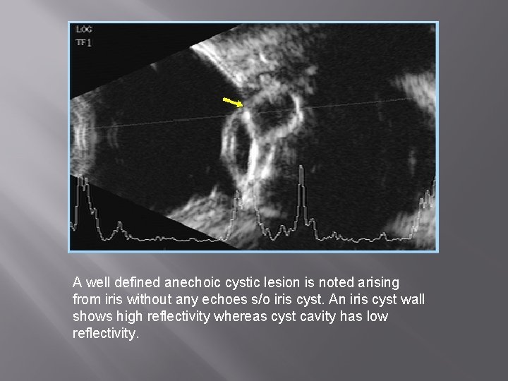 A well defined anechoic cystic lesion is noted arising from iris without any echoes